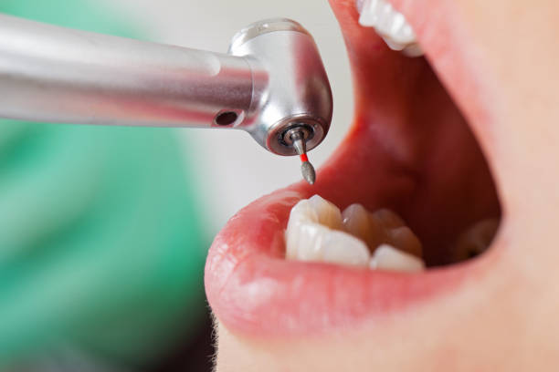 Best Emergency Root Canal Treatment in Duncanville, TX